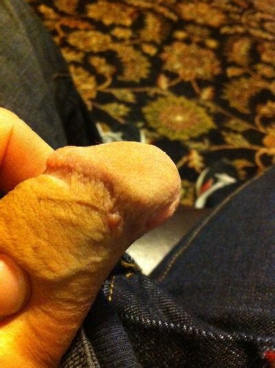 bumps on my penis big nipples fucking