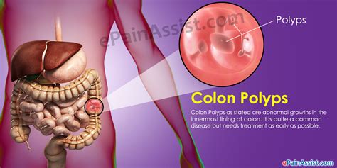 colon polyps treatment prevention  symptoms facts