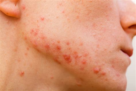 Vital Health Inc Provides Tips On How To Combat Cystic Acne Through