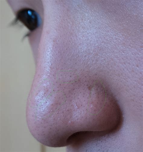 skin bump  nose