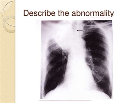 abnormal chest radiograph part