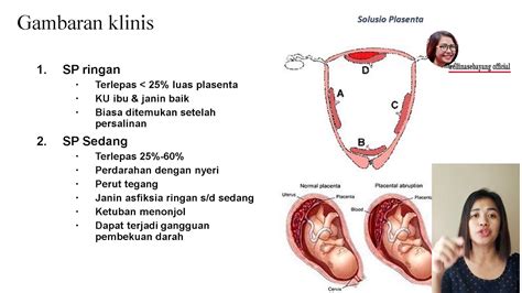 Perdarahan Antepartum Perdarahan Hamil Lanjut Plasenta Previa