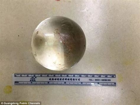 Chinese Man Has A 3in Wide Glass Ball Stuck In His Rectum