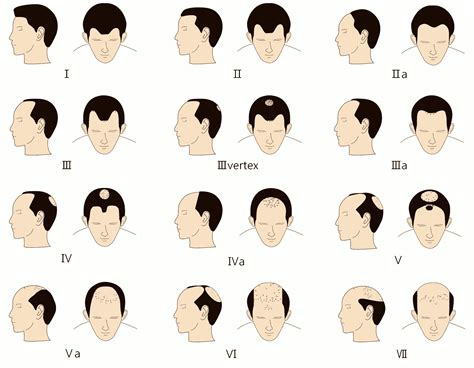 korea hair transplant center hair loss  men  treatment methods