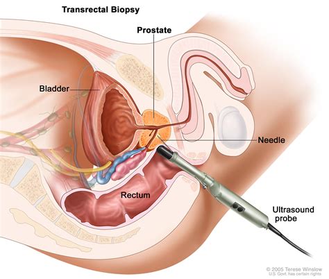 prostate cancer treatment pdq® patient version