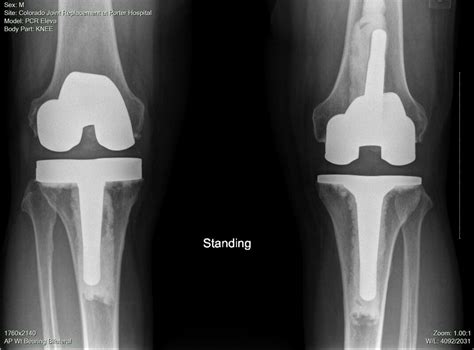 two complete total knee revisions the partial knee replacements failed