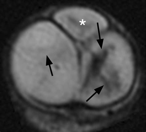 mr imaging of nonmalignant penile lesions radiographics