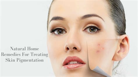 natural home remedies  treating skin pigmentation
