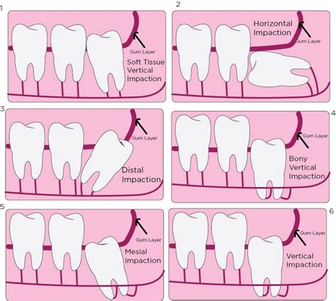 graphic illustrating impaction