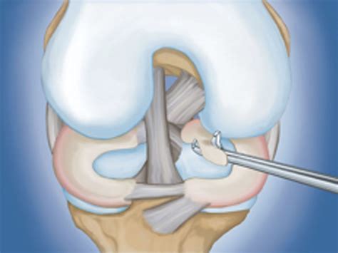 meniscus tears  knee arthroscopic surgery   alosh orthopedics