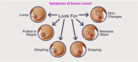 Understanding Breast Cancer Prognosis And Life Expectancy ~ Medical
