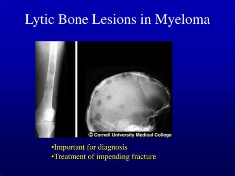 diagnosis  treatment  multiple myeloma powerpoint