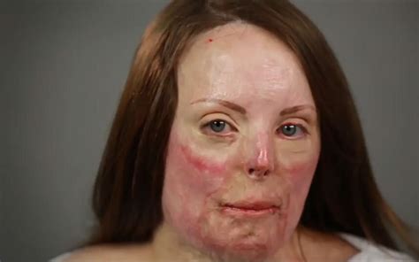 video watch burn survivor s scars disappear in this amazing time lapse