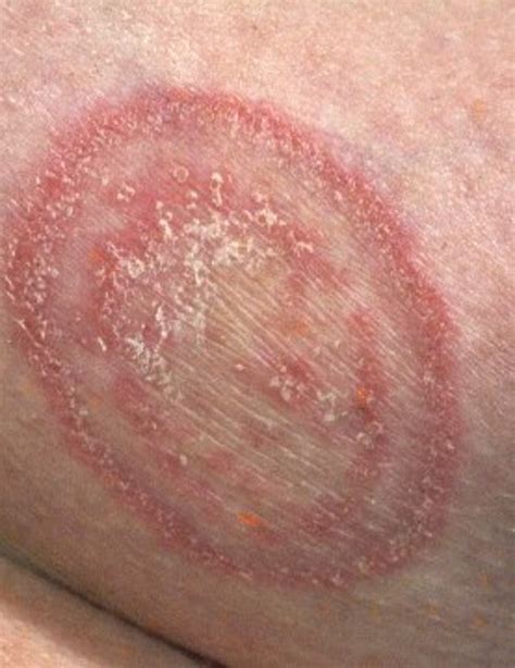 natural fungal infection treatment  essential oils