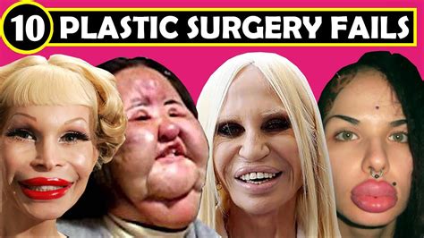 Top 10 Botched Plastic Surgery Fails Plastic Surgery Before And