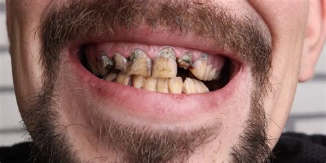 teeth scaling  polishing remove cigarette smoking stains