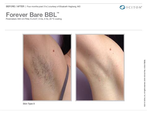 brazillian bikini laser hair removal nude photos