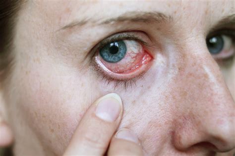 symptoms  eye infection