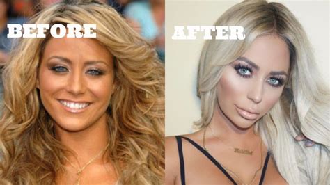 reality stars before and after plastic surgery