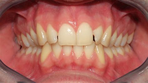 denti dritti   mesi ortodonzia torino