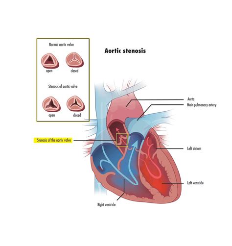 aortic stenosis cardiovascular medbullets step