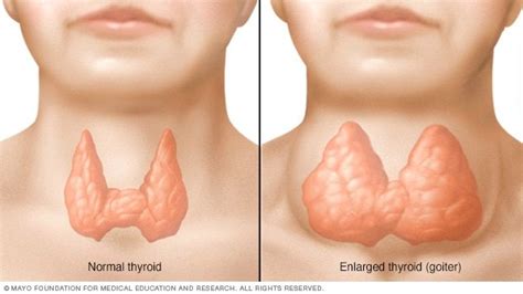 goiter symptoms and causes mayo clinic thyroid