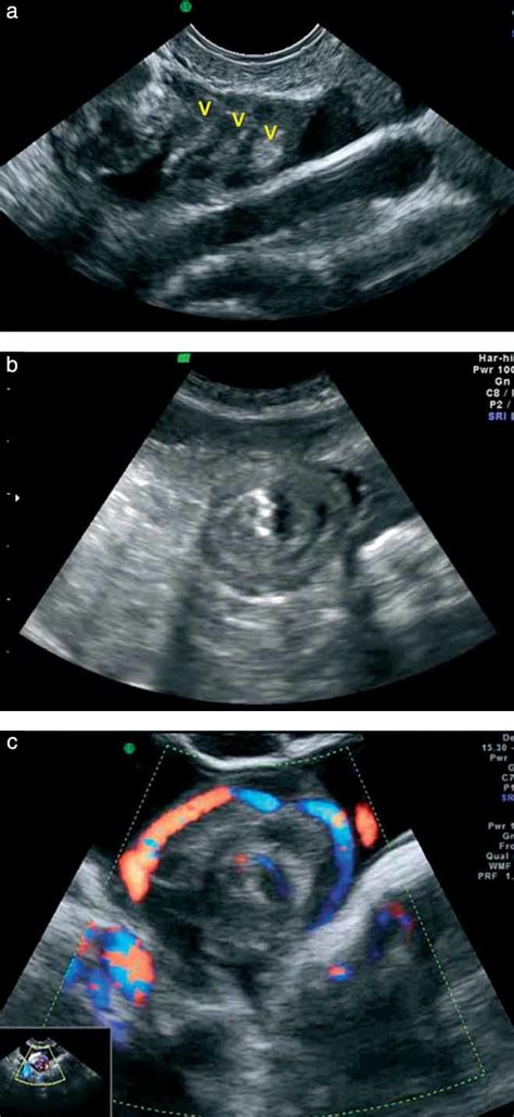 whirlpool sign   diagnosis  adnexal torsion  atypical clinical  valsky