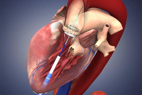Promising Results In Heart Valve Clinical Trial The New York Times