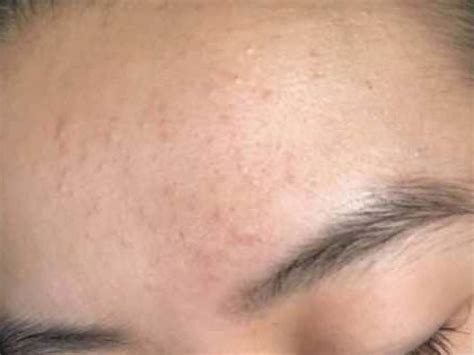 fungal acne moisturizer  sellers save  jlcatjgobmx