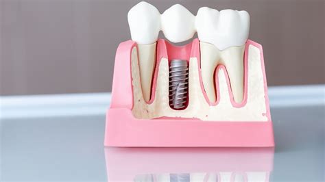 quanto custa um implante dentário clinica oraldents