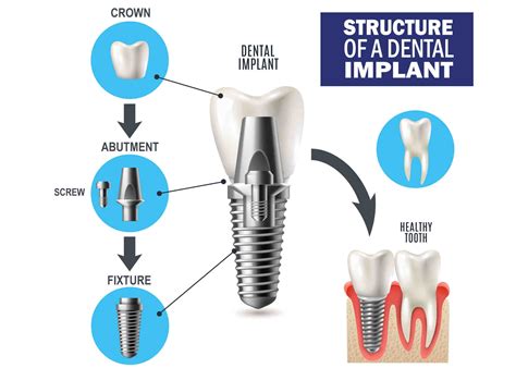 abutment  dental implant dental news network