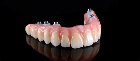 pose de protheses dentaires  chisinau protheses dentaires  la clinique dentaire saniodent