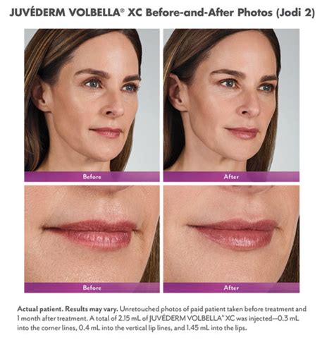 juvÉderm volbella® and juvÉderm voluma® xc for lips and cheeks hayes