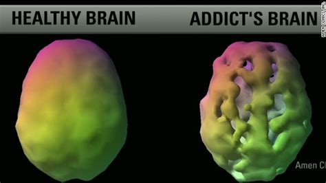 spect scans of brain on drugs my xxx hot girl