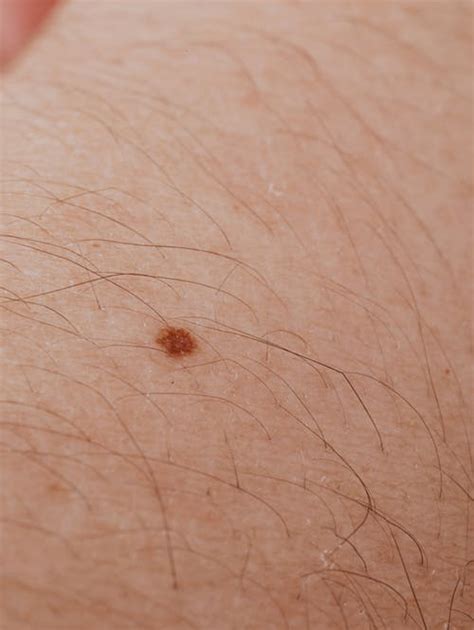 five unusual skin growths some that are cancerous