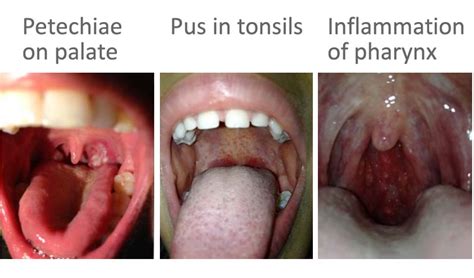 Strep Throat Causes Symptoms And Treatment – Nursa