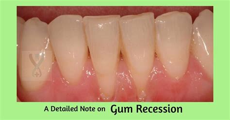 detailed note  gum recession expert dental care