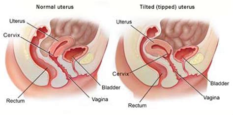 Pain in ovary after sex