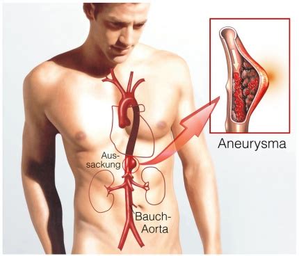 aneurysma ursachen beschwerden therapie gesundpediade