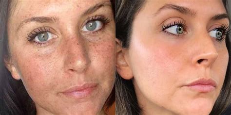This Woman’s Reddit Before And After Sun Damage Photo Is Going Viral