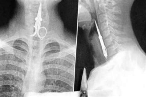 Incredible X Ray Of Scissors Stuck In Man S Throat Plus