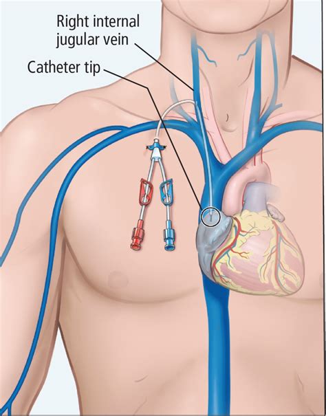 can i place a peripherally inserted central catheter in my patient with