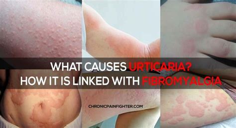 urticaria also know as hives is a skin condition which