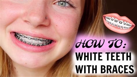 how to get pearly white teeth with braces teethwalls