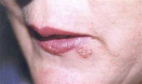 cold sores pictures symptoms treatment causes home remedies