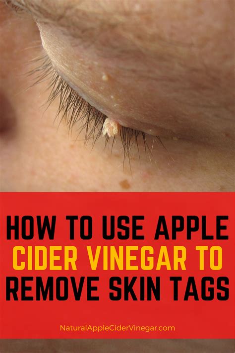 how to use apple cider vinegar to remove skin tags skin tag removal