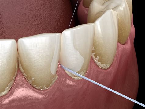 dentist  dallas ga  reasons  floss  day dental health