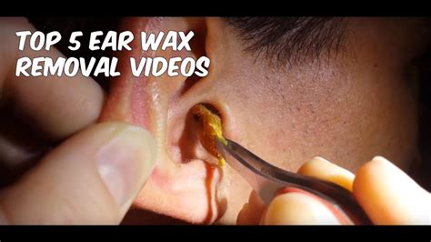 top  ear wax removal   satisfying youtube
