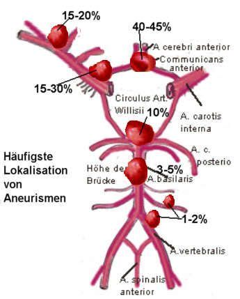 avm aneurysm awareness avm netherlands  facebook aneurysm