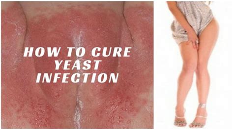 Natural Cure For Yeast Infection In Depth Review